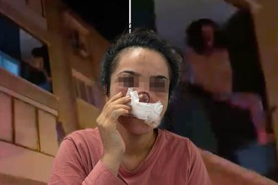 Burnu koparılan kadın dehşet anlarını anlattı: Bir anda boynuma sarılıp ısırdı